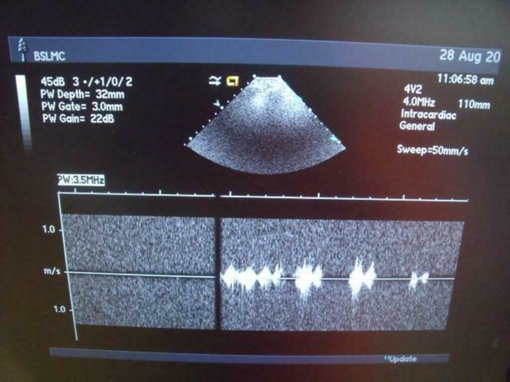 ACUSON 47446-93742503 4V2 ULTRASOUND PROBE | PR5320 DIAGNOSTIC ULTRASOUND MACHINES FOR SALE