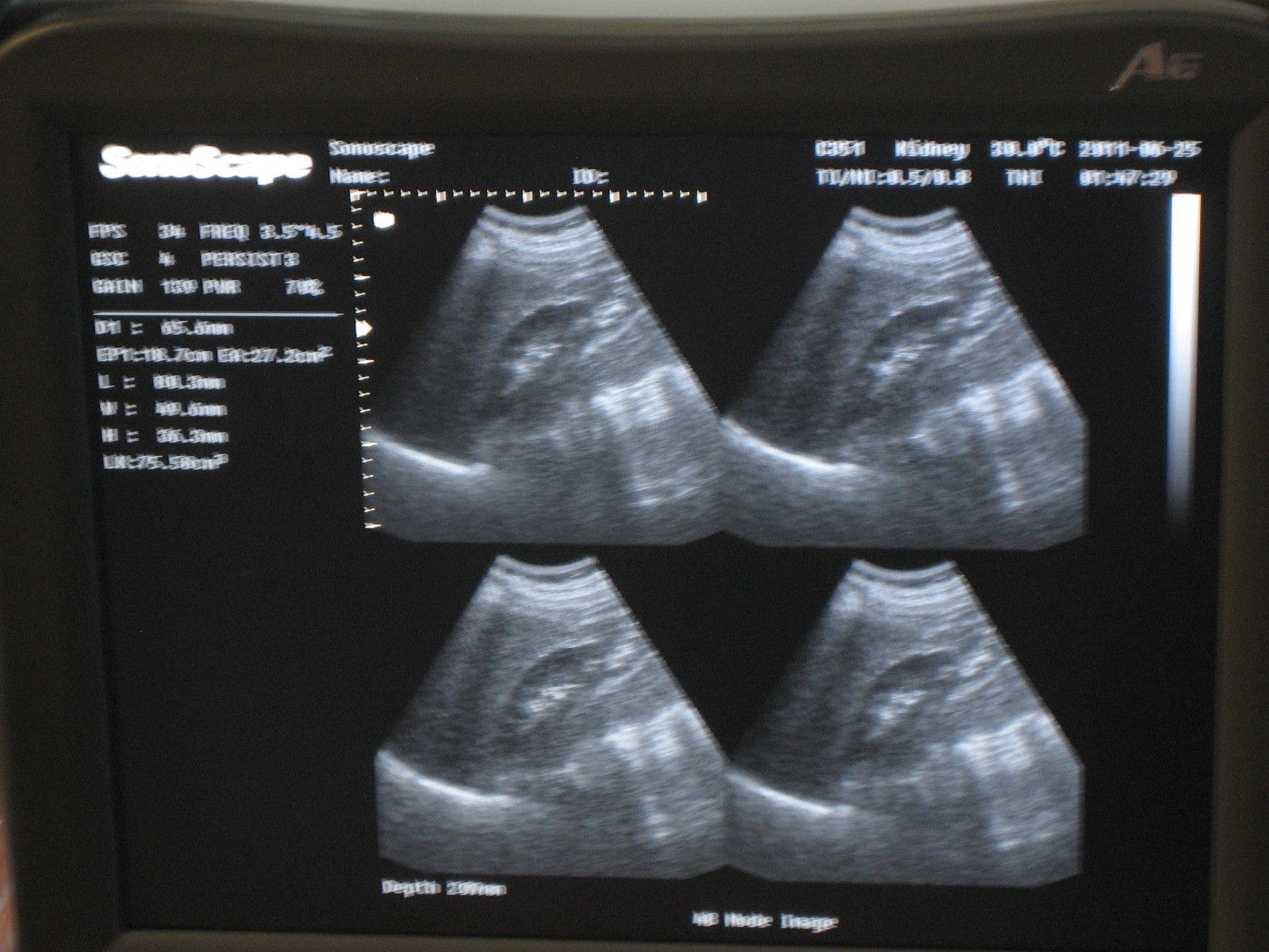 Ultrasound SonoScape A6 B/W  with  Convexo and Endovaginal DIAGNOSTIC ULTRASOUND MACHINES FOR SALE