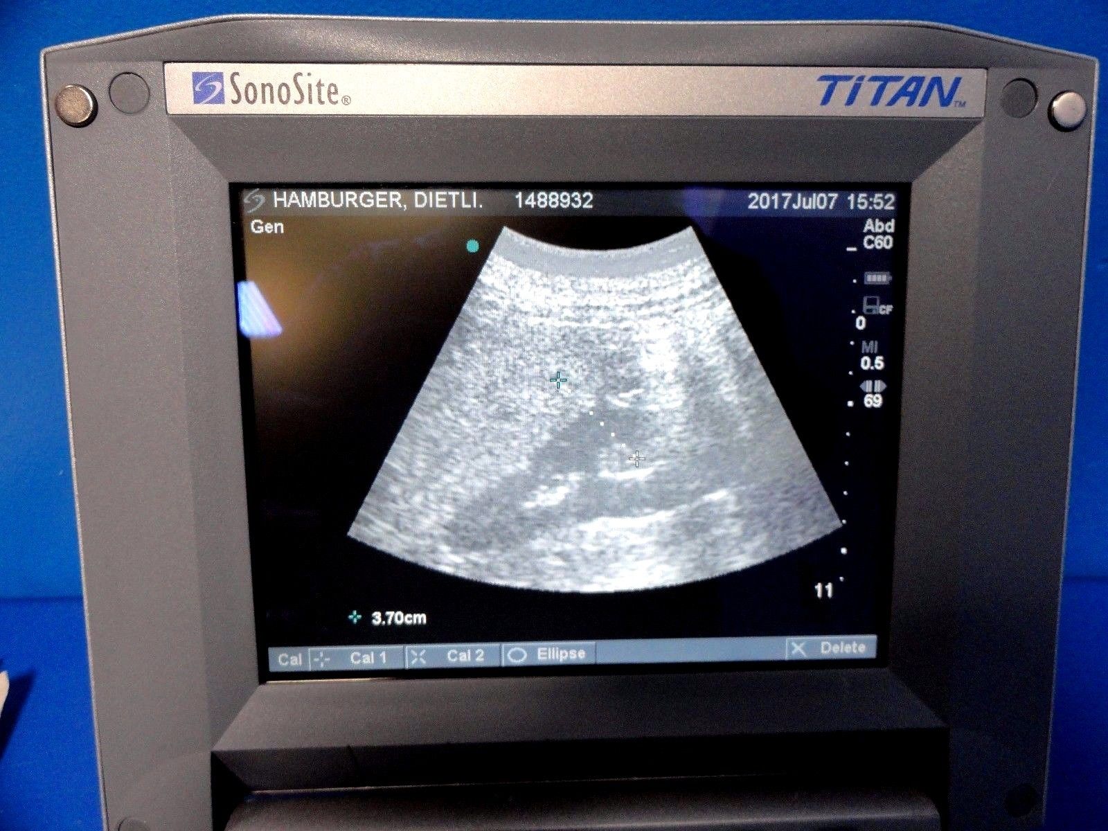 SONOSITE TITAN Ultrasound W/ C60/5-2 Convex Array & ICT/8-5MHz Transducer ~12904 DIAGNOSTIC ULTRASOUND MACHINES FOR SALE