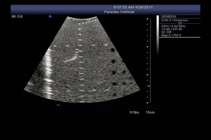 Siemens CH6-2 Ultrasound Probe DIAGNOSTIC ULTRASOUND MACHINES FOR SALE