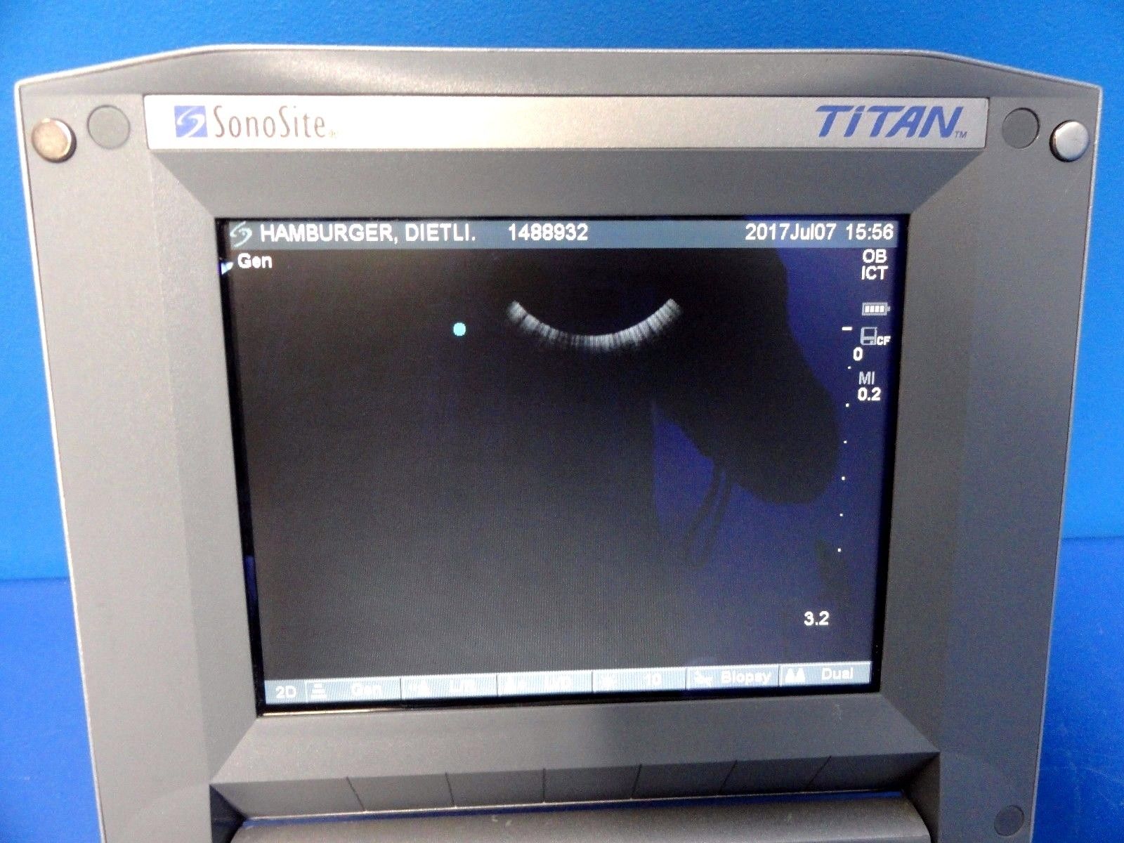 SONOSITE TITAN Ultrasound W/ C60/5-2 Convex Array & ICT/8-5MHz Transducer ~12904 DIAGNOSTIC ULTRASOUND MACHINES FOR SALE