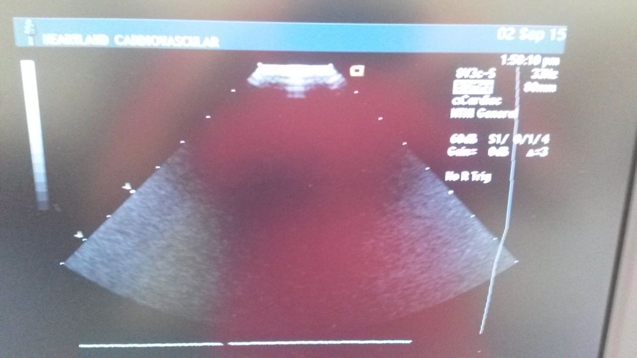 Siemens Sequoia 8v3 linear probe DIAGNOSTIC ULTRASOUND MACHINES FOR SALE