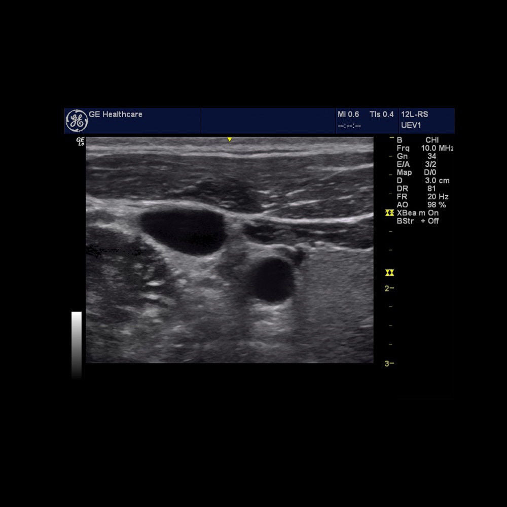 ultrasound imaging