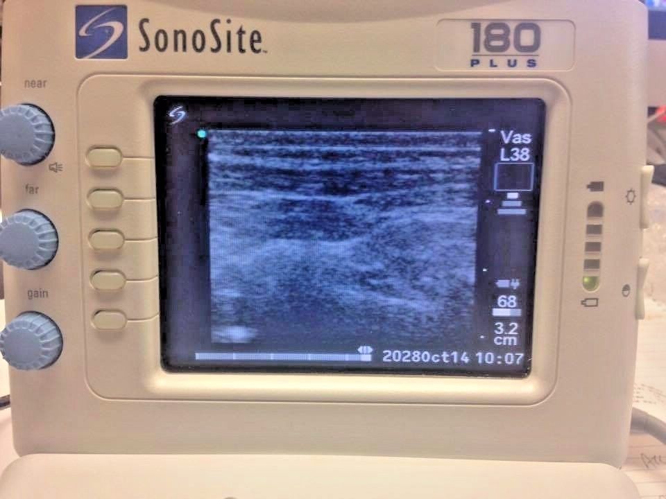 Sonosite 180 Plus Hand Carried Ultrasound System W/ Probe. BIOMED Certified. DIAGNOSTIC ULTRASOUND MACHINES FOR SALE