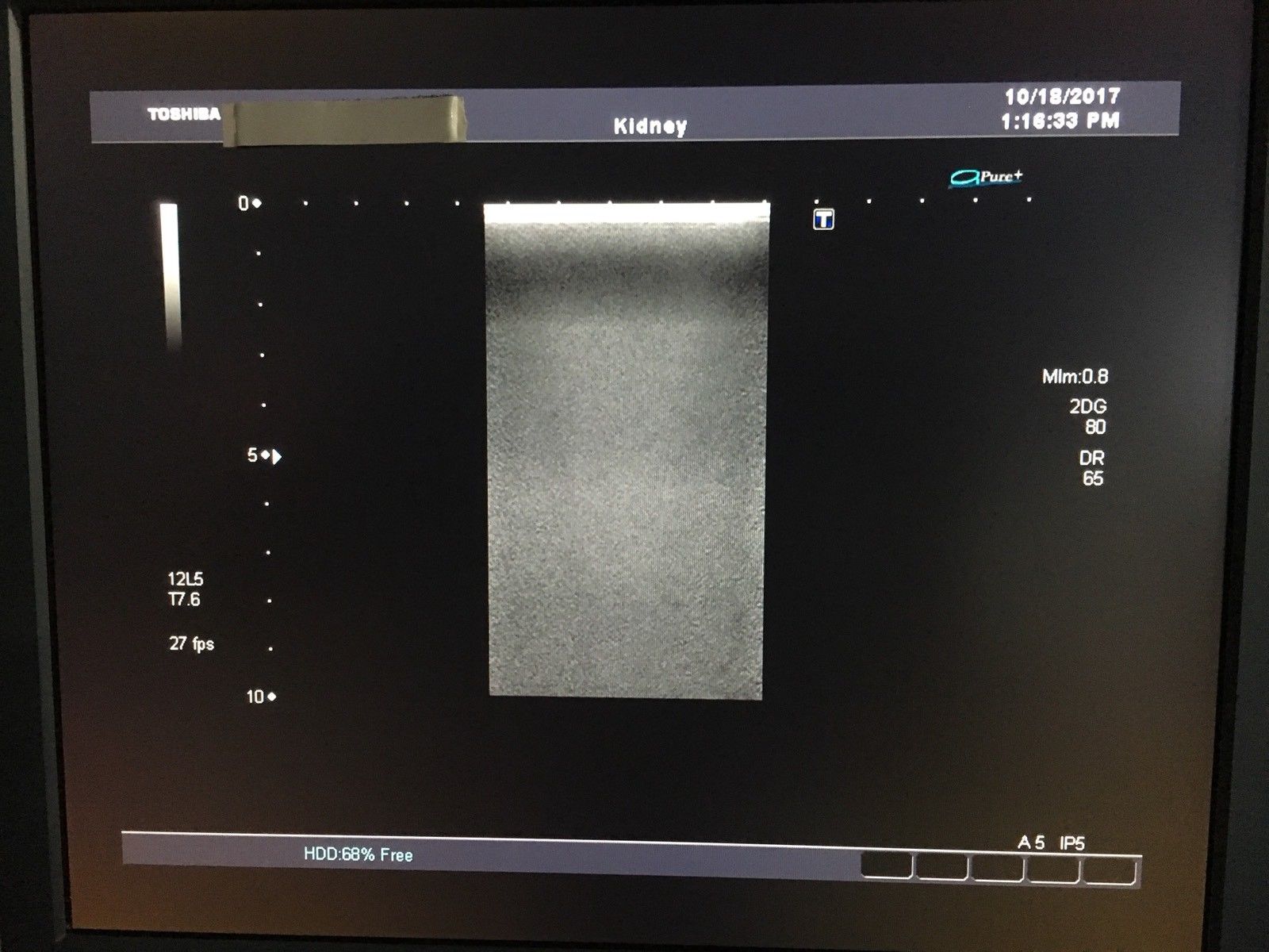 Toshiba Aplio PLT-805AT Ultrasound Linear Transducer Probe 8 Mhz DIAGNOSTIC ULTRASOUND MACHINES FOR SALE