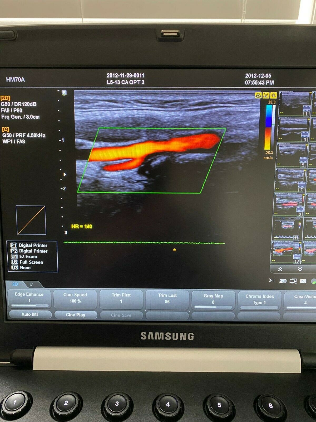 Samsung HM70 portable HM70A with Plus portable Ultrasound machine - 3 probes DIAGNOSTIC ULTRASOUND MACHINES FOR SALE