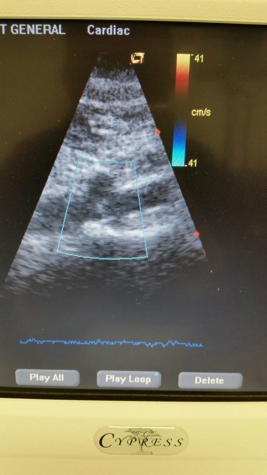 Acuson Cypress Cardiac Vascular Ultrasound Machine Rev 14 + CW, 3V2c, 7L3 Probe DIAGNOSTIC ULTRASOUND MACHINES FOR SALE