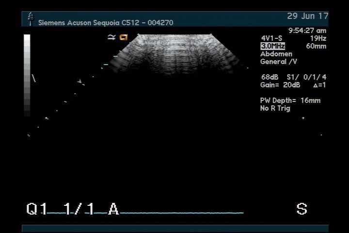 Acuson 4V1 for Sequoia 512 Ultrasound Transducer DIAGNOSTIC ULTRASOUND MACHINES FOR SALE