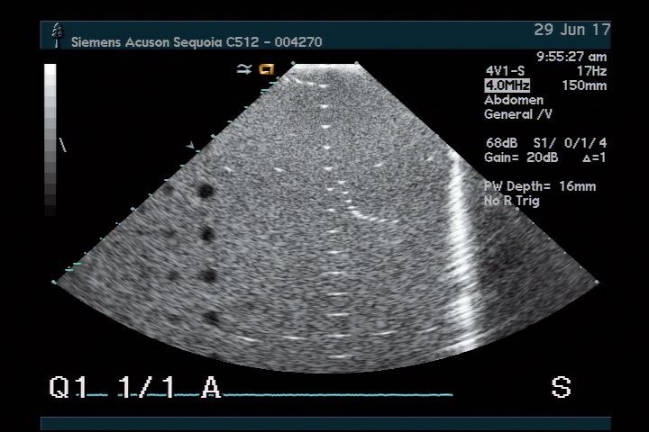 Acuson 4V1 for Sequoia 512 Ultrasound Transducer DIAGNOSTIC ULTRASOUND MACHINES FOR SALE