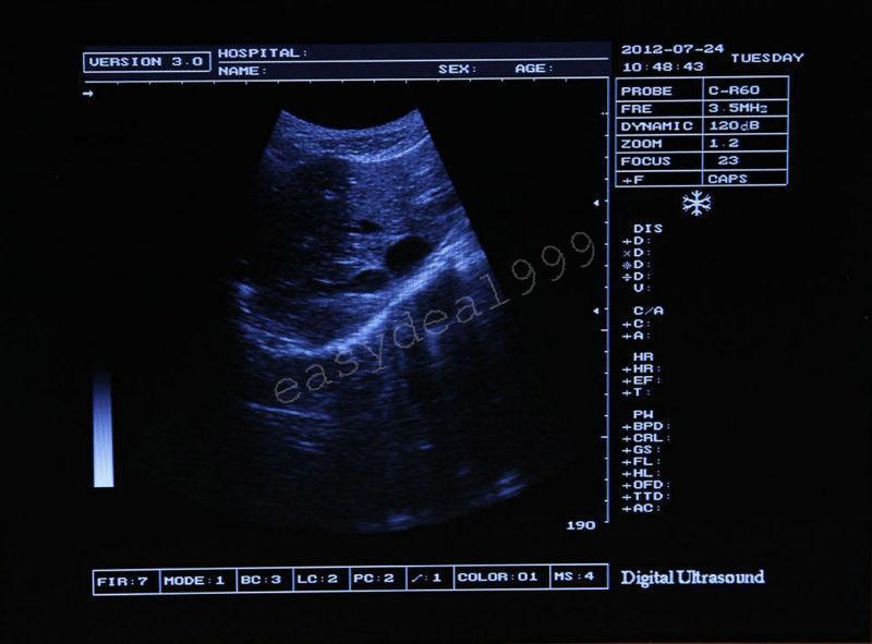 LCD Full Digital Portable Ultrasound Scanner Machine Convex Transvaginal 2 Probe DIAGNOSTIC ULTRASOUND MACHINES FOR SALE