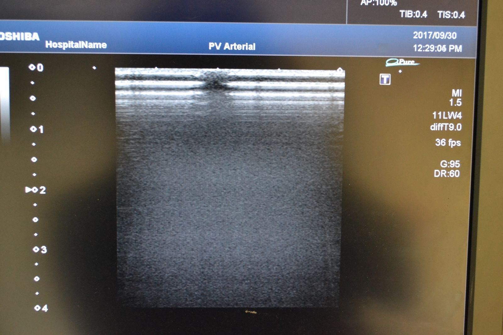 Toshiba Artida PLT-704SBT 11-4.8MHz Linear Ultrasound Transducer Probe DIAGNOSTIC ULTRASOUND MACHINES FOR SALE