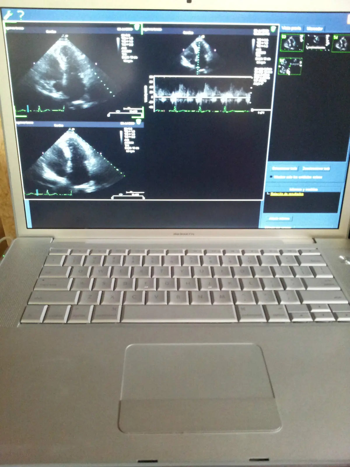 Siemens P50 Portable Ultrasound System With Linear Transducer Offer Price DIAGNOSTIC ULTRASOUND MACHINES FOR SALE