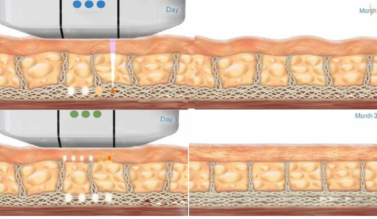 High Intensity Focused Ultrasound Hifu Skin Rejuvenation Anti-Wrinkle Machine DIAGNOSTIC ULTRASOUND MACHINES FOR SALE